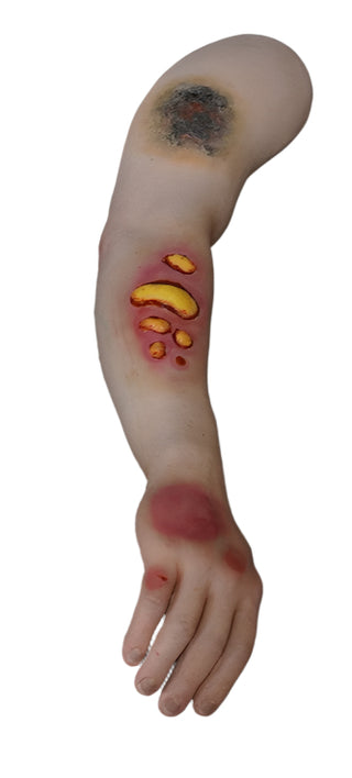 Dura Nate Arm with 1st, 2nd  and 3rd Degree Burns