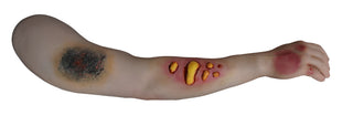 Dura Nate Arm with 1st, 2nd  and 3rd Degree Burns